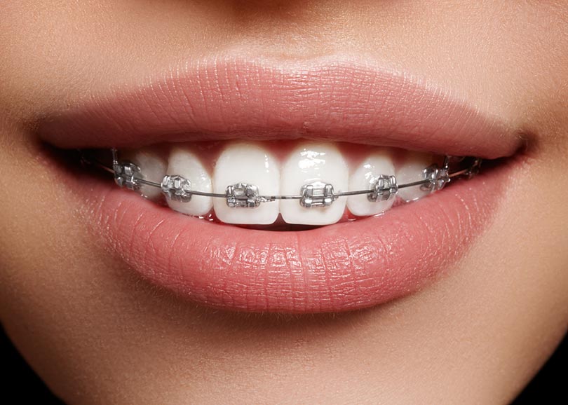 Can You Drink Coffee with Braces? Tips to Minimize Braces Discomfort